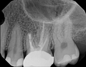 3 months after apicoectomy