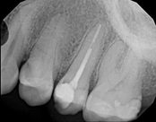 After root canal treatment