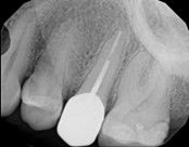 6 months after root canal treatment