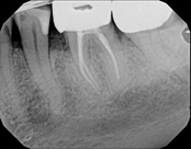 6 months after root canal treatment