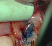 Before mid-root crack repair