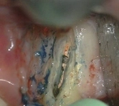 After mid-root crack removal