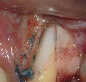 Before mid-root crack repair