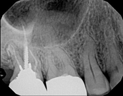 Root canal treatment