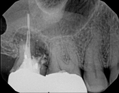 Root canal treatment