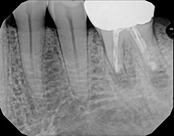 3 months after microsurgery