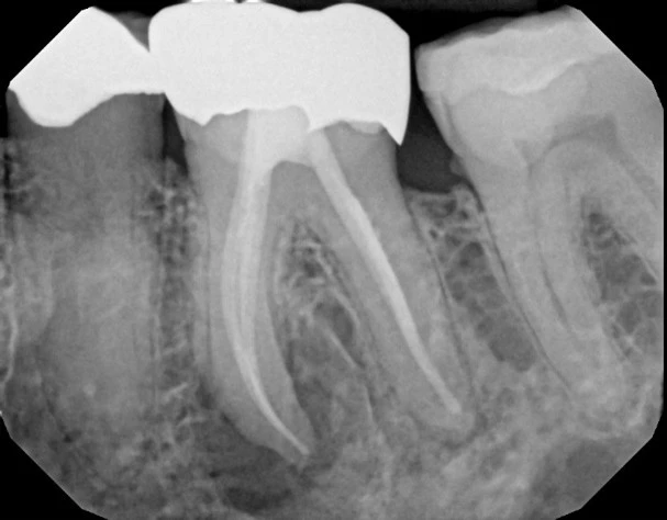 Apicoectomy Xray