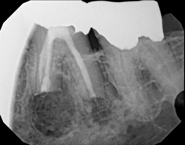 Apicoectomy Xray