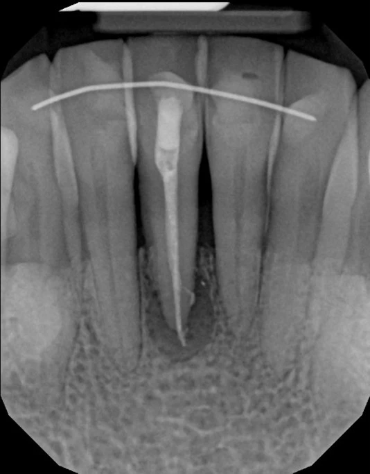 Apicoectomy Xray