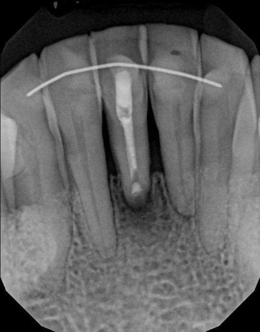 Apicoectomy Xray